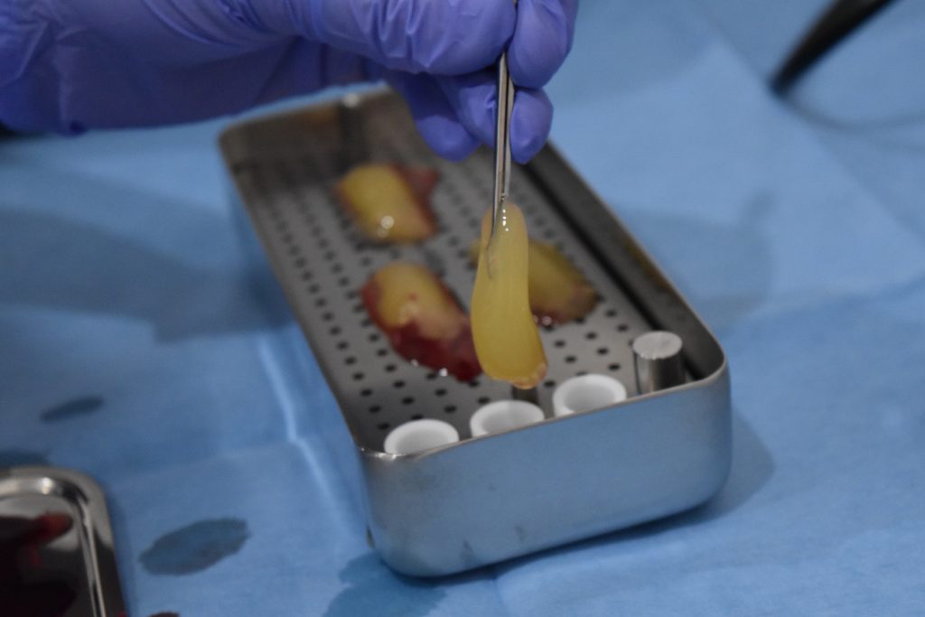 Fot. 6. Przygotowanie A-PRF w postaci plug; fot. archiwum autorów