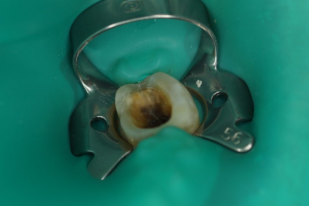 zespół pękniętego zęba