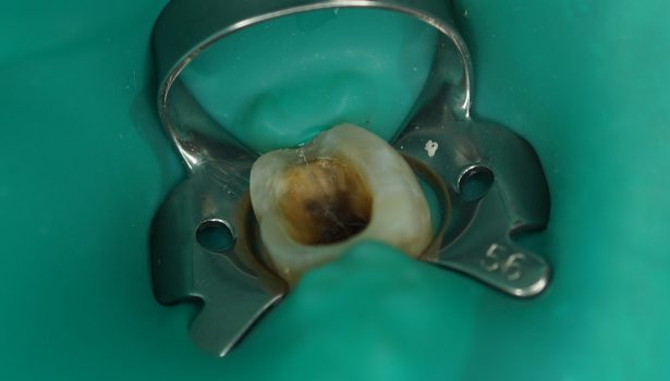 zespół pękniętego zęba