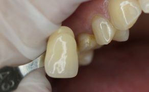 Odbudowa korony zęba