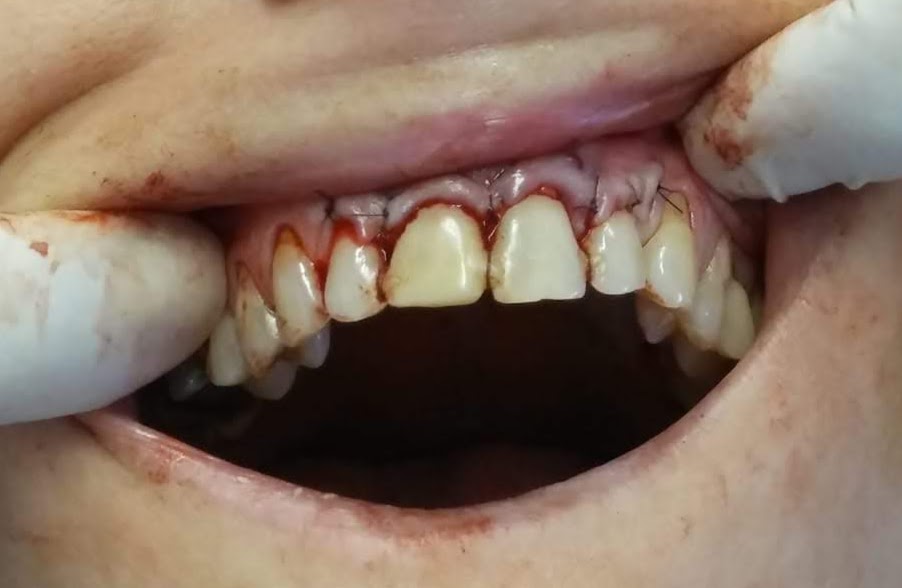 Fot. 9. Pacjentka nr 2 – stan kliniczny bezpośrednio po zabiegu