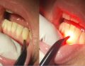 Ryc. 5a-b. Znoszenie nadwrażliwości zębiny z użyciem światłowodu 2 mm