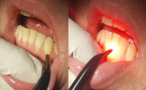 Ryc. 5a-b. Znoszenie nadwrażliwości zębiny z użyciem światłowodu 2 mm