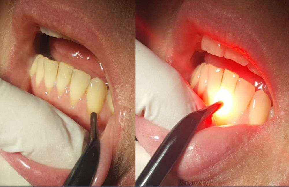 Ryc. 5a-b. Znoszenie nadwrażliwości zębiny z użyciem światłowodu 2 mm