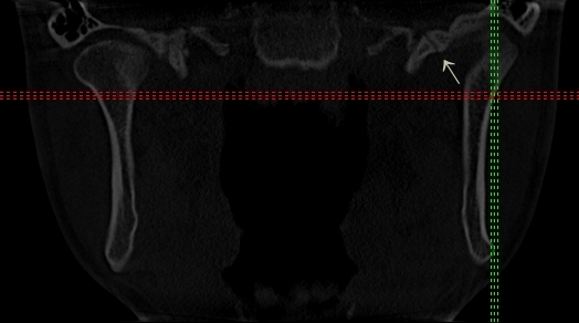 Fot. 1. CBCT – przekrój czołowy: poszerzona szczelina skalistobębenkowa po stronie lewej w obrębie struktur panewki stawu skroniowo-żuchwowego lewego