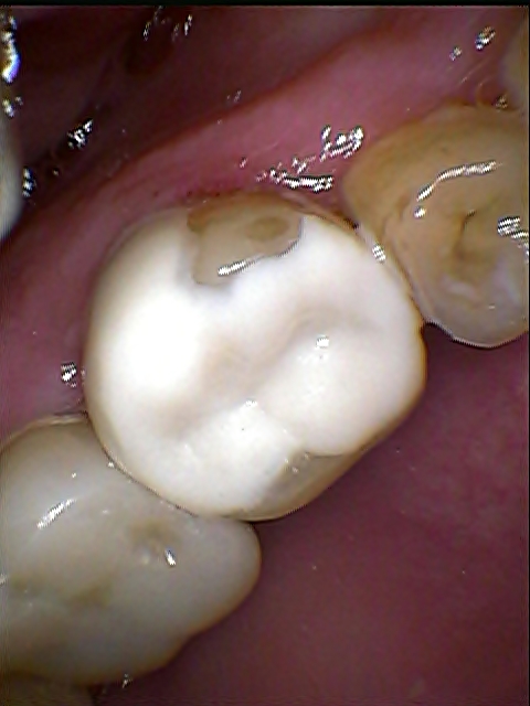 Fot. 1b. Pacjent B.K., ząb 26 po rekonstrukcji biomimetycznej Zirconomer Improved bezpośrednio po aplikacji