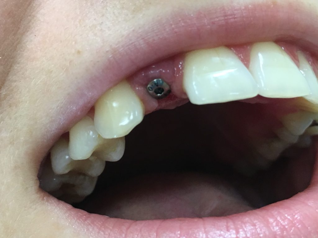 Fot. 7. Śruba gojąca