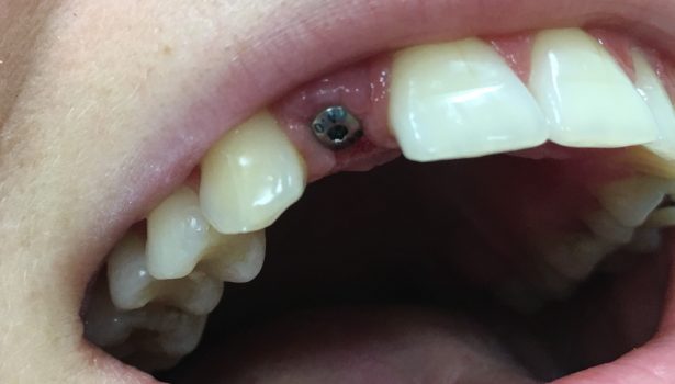 Fot. 7. Śruba gojąca