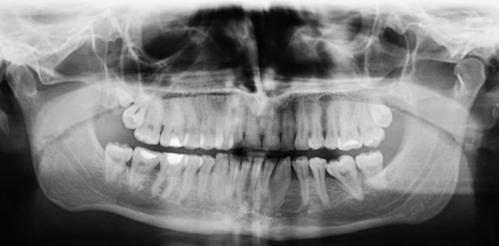 tps-4-2019-zęby-zatrzonowe-Ryc1