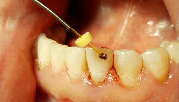 Alternatywna metoda leczenia choroby przyzębia – LANAP, LAPIP