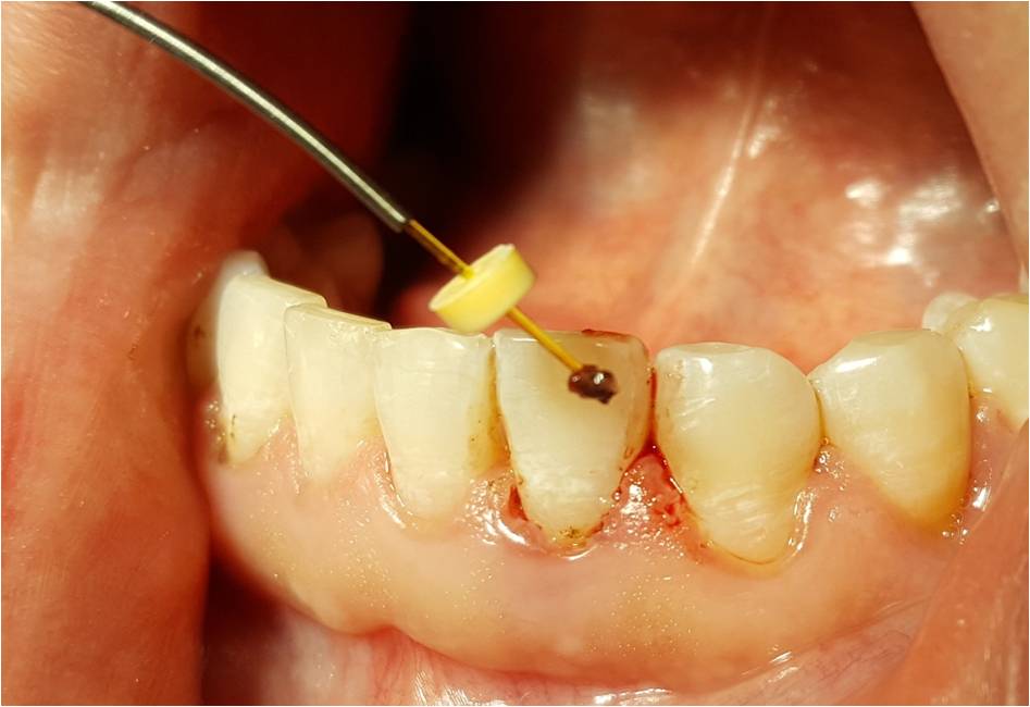 Alternatywna metoda leczenia choroby przyzębia – LANAP, LAPIP