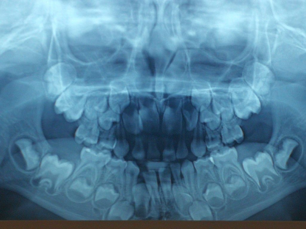 Nowoczesne aparaty ortodontyczne szansą na korektę estetyki twarzy