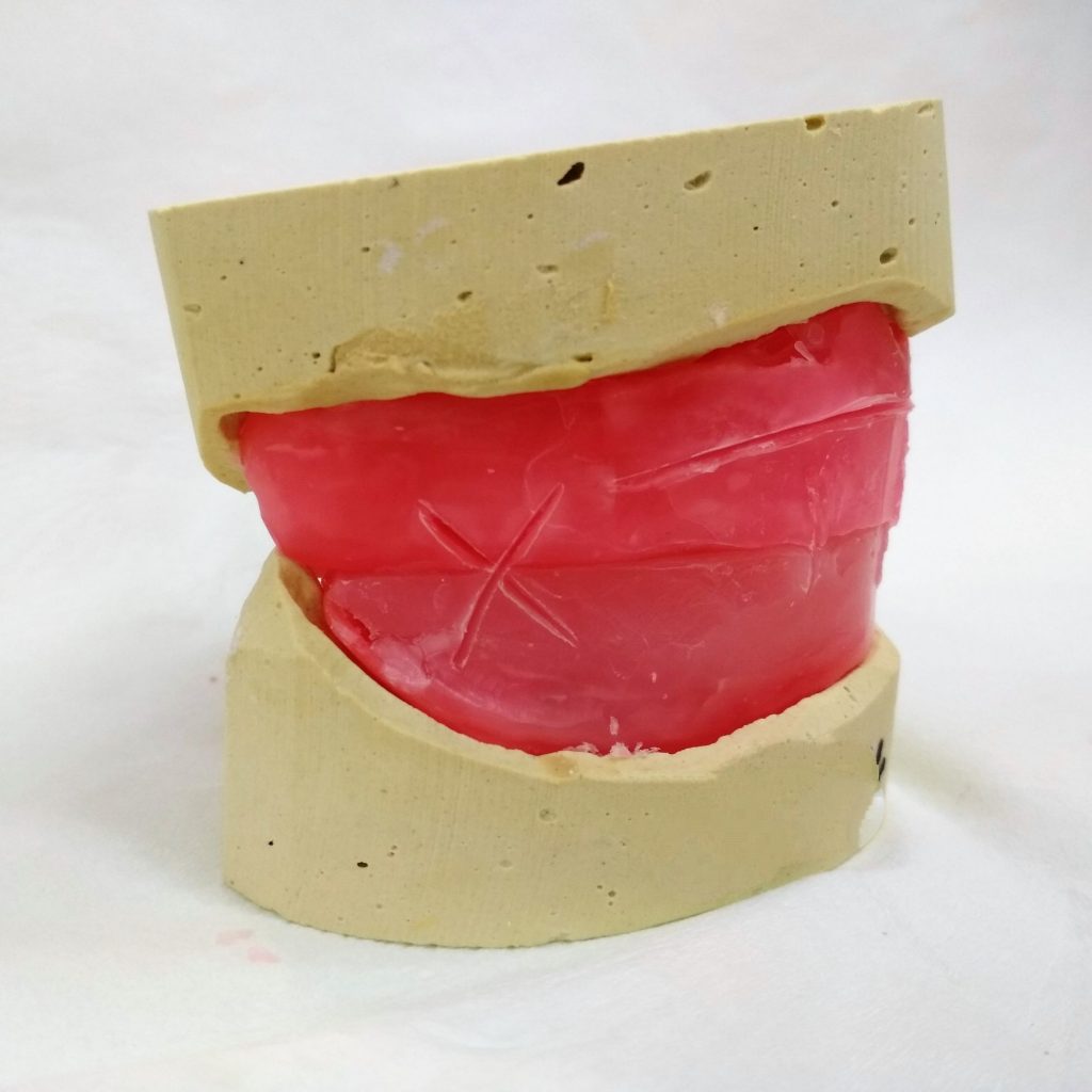 Fot. 4. Błąd w postaci kontaktu gipsowej części dolnego modelu z wałem woskowym górnego wzornika