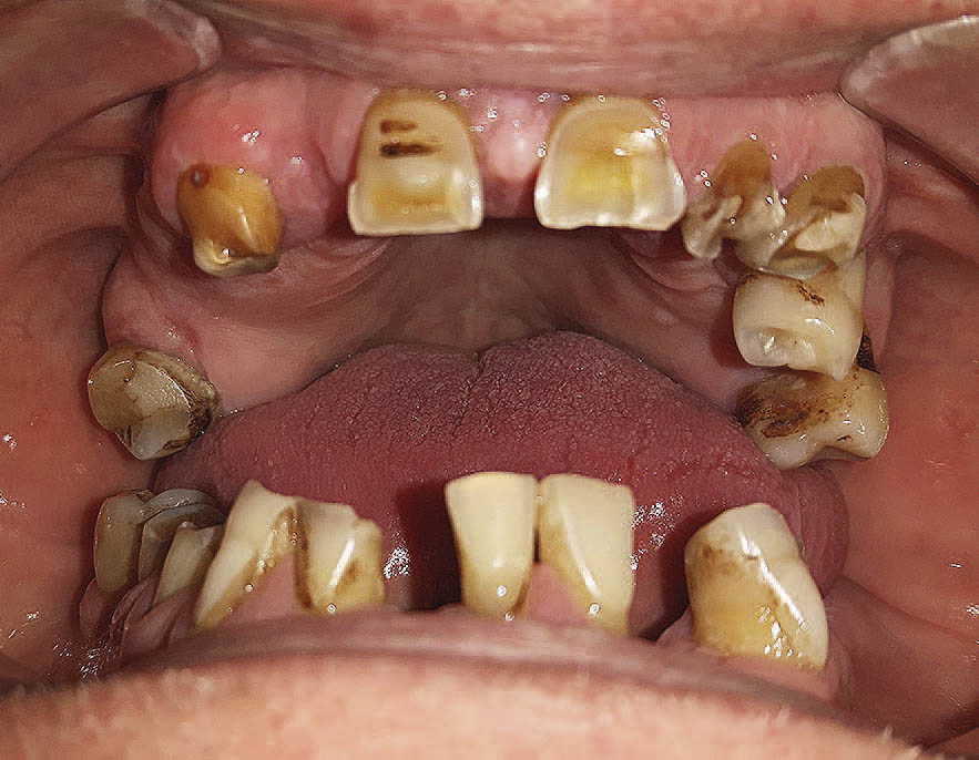 rekonstrukcja zwarcia