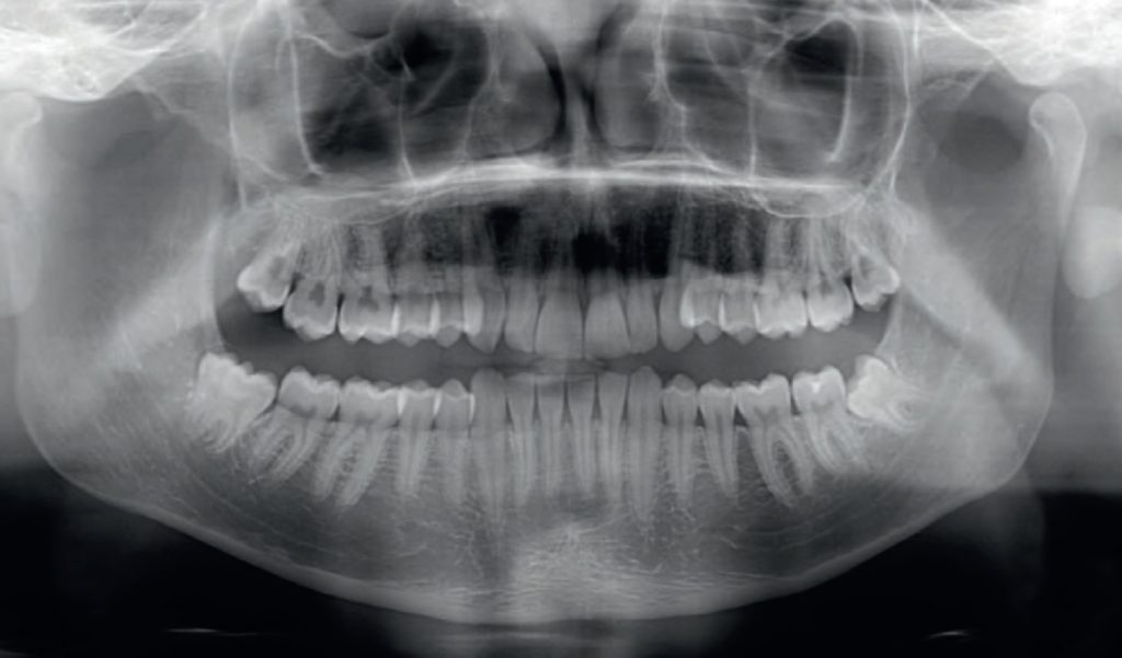 Dystalizator Carriere Motion