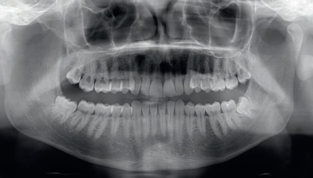 Dystalizator Carriere Motion