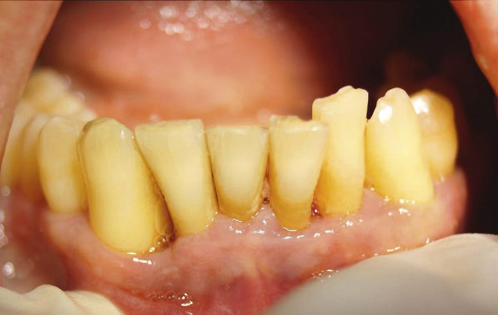 terapia fotodynamiczna