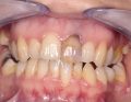 tps-9-2019-wybielanie-zębów-fot.2