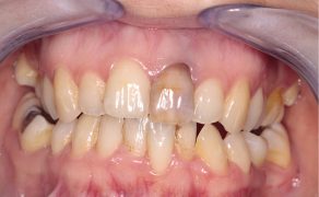 tps-9-2019-wybielanie-zębów-fot.2