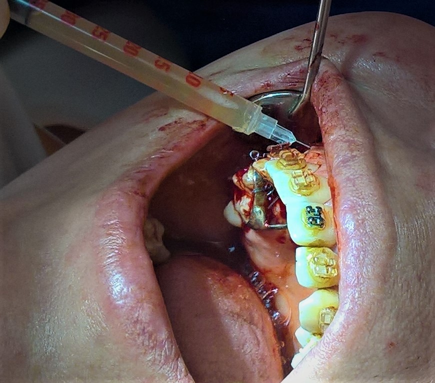 Zastosowanie masy bogatopłytkowej w zabiegu implantacji u pacjenta z nieprawidłowościami obrazu krwi