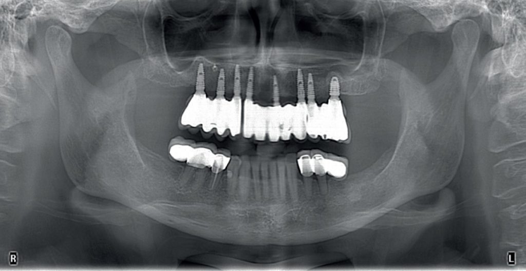 Wymiana protezy ruchomej na uzupełnienie stałe na implantach
