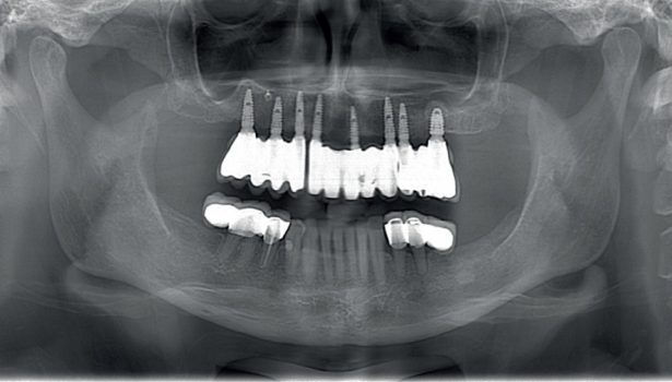 Wymiana protezy ruchomej na uzupełnienie stałe na implantach