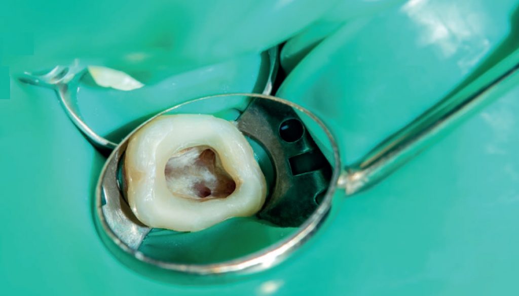 Jak najlepiej odkazić kanały korzeniowe? Aktualny schemat postępowania na podstawie przeglądu piśmiennictwa