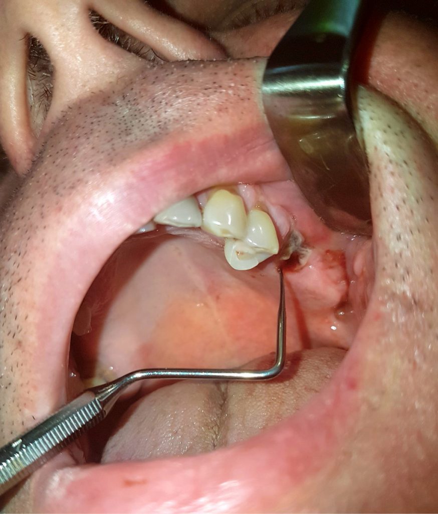 powikłania podczas ekstrakcji