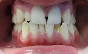przygotowanie ortodontyczne