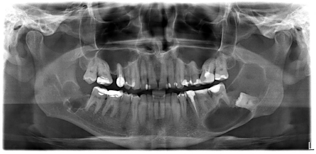 sterowana regeneracja kostna