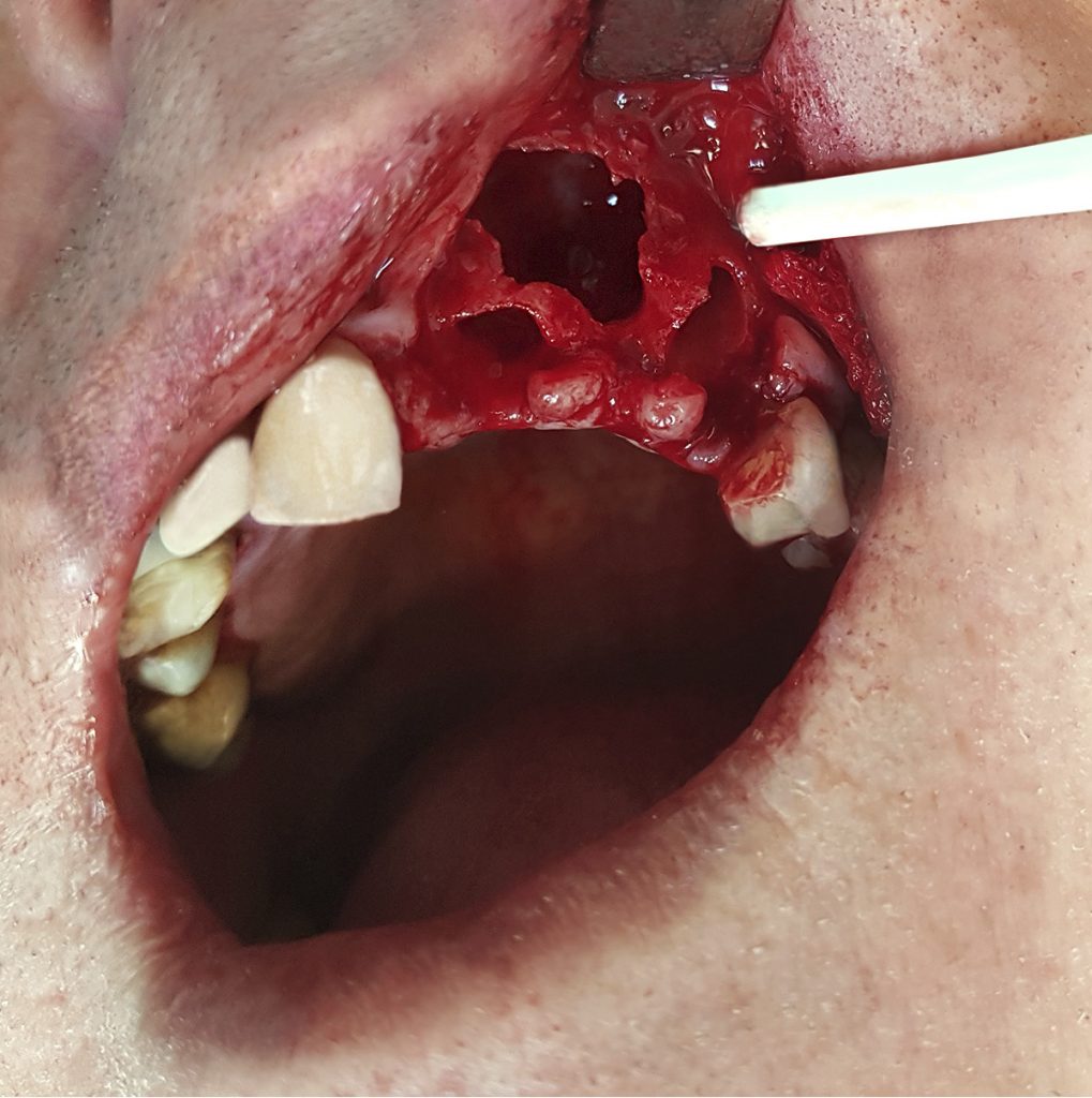 tps-7-8-2019-torbiel-rogowaciejąca-fot.2