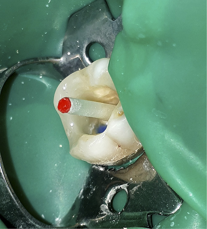 tps-9-2019-wkłady-koronowo-korzeniowe-fot.6