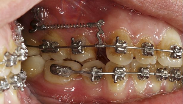 zmodyfikowana płytka Bollarda