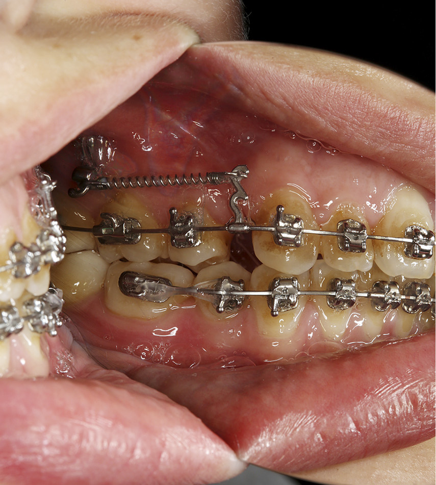 zmodyfikowana płytka Bollarda