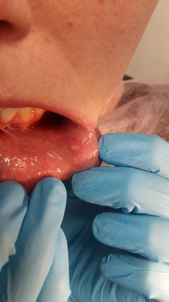 Leczenie aft nawracających