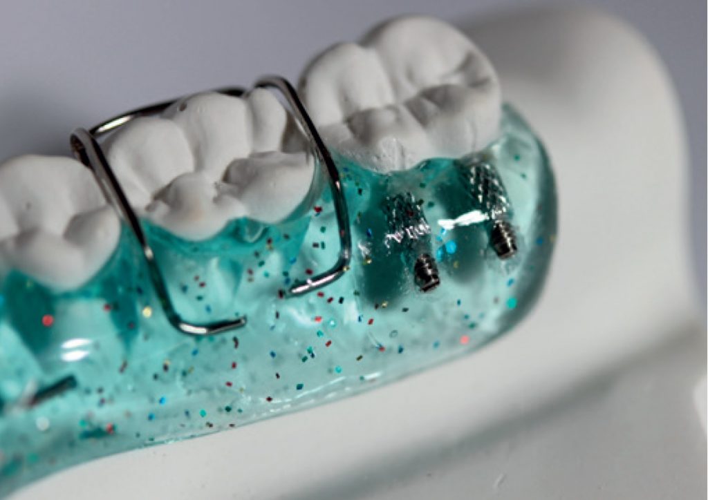 Kliniczne zastosowanie śrub specjalnych w zdejmowanych aparatach ortodontycznych