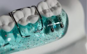 Kliniczne zastosowanie śrub specjalnych w zdejmowanych aparatach ortodontycznych