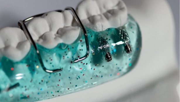 Kliniczne zastosowanie śrub specjalnych w zdejmowanych aparatach ortodontycznych