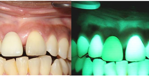 Velscope Vx – sposób na wczesne wykrycie zmian nowotworowych w gabinecie stomatologicznym