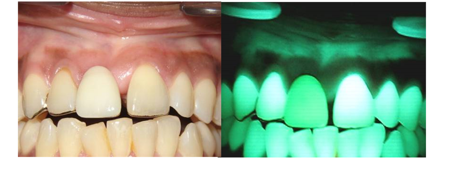 Velscope Vx – sposób na wczesne wykrycie zmian nowotworowych w gabinecie stomatologicznym