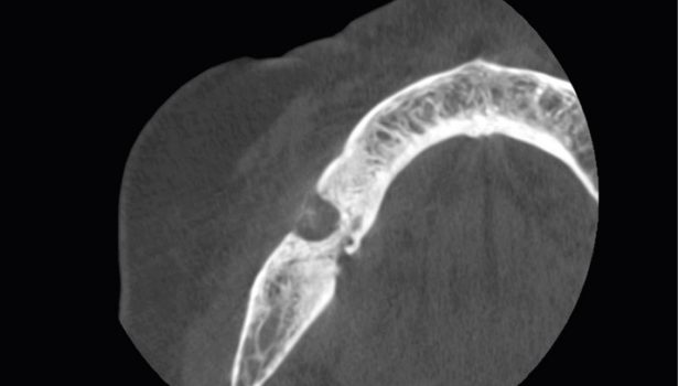 Fot. 1. Badanie CBCT pierwszego ogniska polekowej martwicy kości MRONJ w 2018 r.