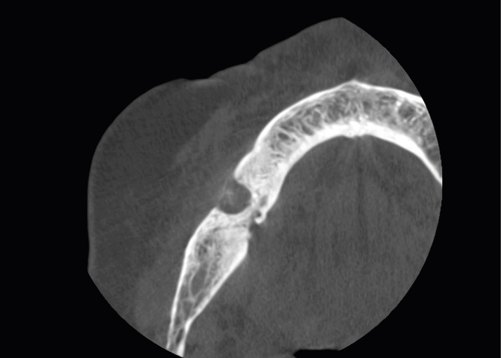 Fot. 1. Badanie CBCT pierwszego ogniska polekowej martwicy kości MRONJ w 2018 r.