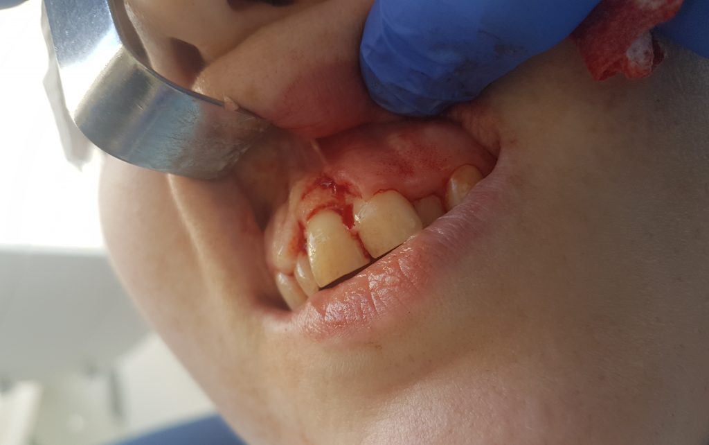 nadziąślak włóknisty