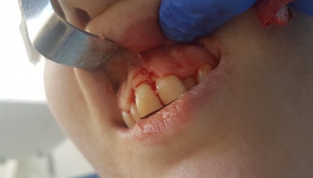 nadziąślak włóknisty