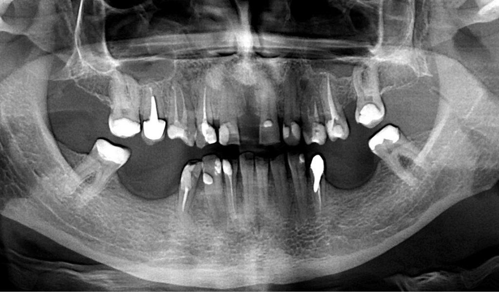Dilaceracja-korzenia-w-przedtrzonowcach