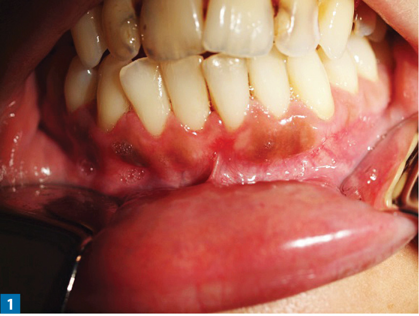 TPS_4_20_PERIODONTOLOGIA_ESTETYCZNA_DEPIGMENTACJA_MELANOZY_DZIASEL_PALACZA_ZA_POMOCA_LASERA_CO2_FOT_1