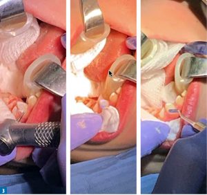 Specyfika zachowawczego leczenia zębów mlecznych