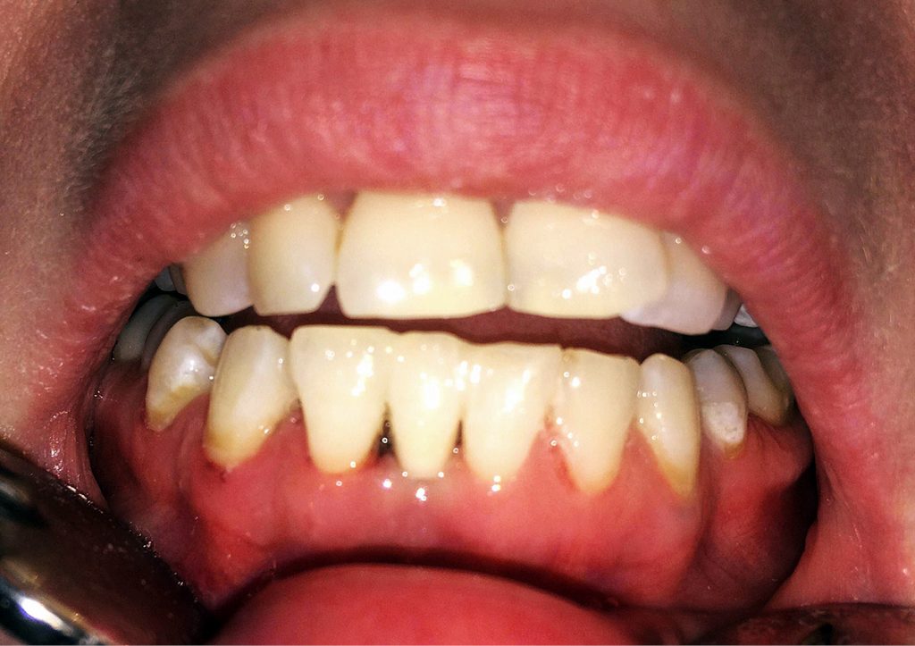 TPS_5_20_periodontologia_URAZOWE_ZNISZCZENIE_PRZYZEBIA_BIZUTERIA_JEZYKA_FOT_4