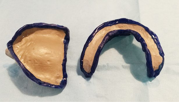 Wyciski czynnościowe w wykonastwie protetycznym