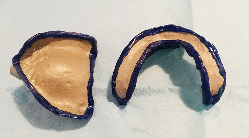 Wyciski czynnościowe w wykonastwie protetycznym